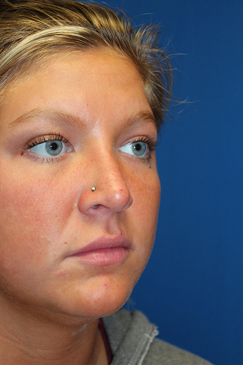 Female Revision Rhinoplasty