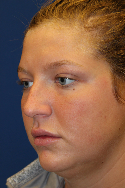 Female Revision Rhinoplasty