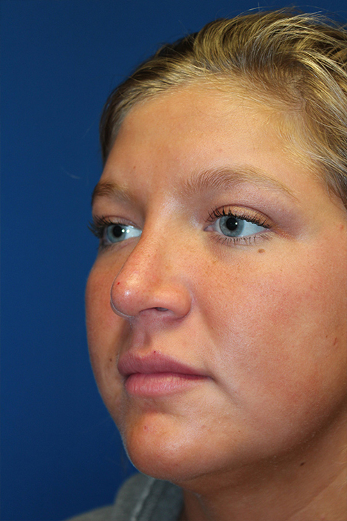 Female Revision Rhinoplasty