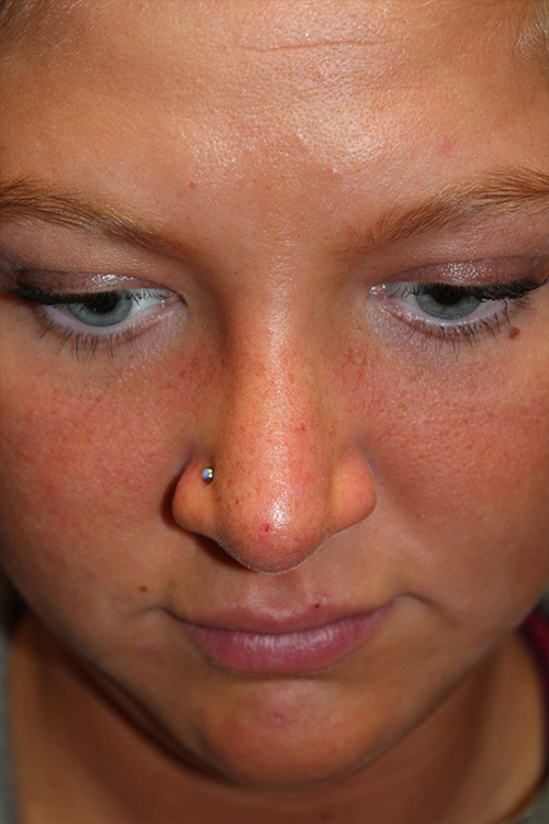 Female Revision Rhinoplasty