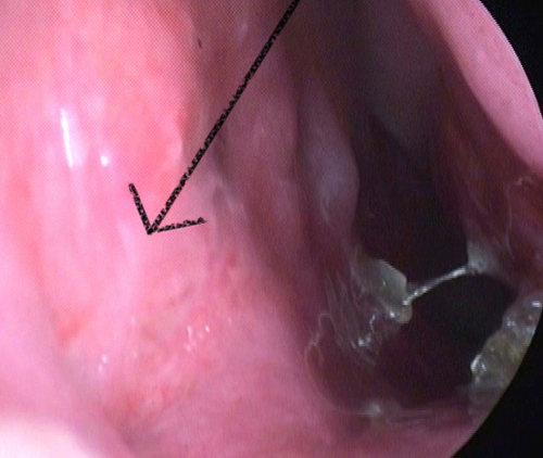 Female Revision Rhinoplasty