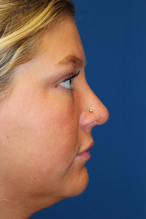 Female Revision Rhinoplasty