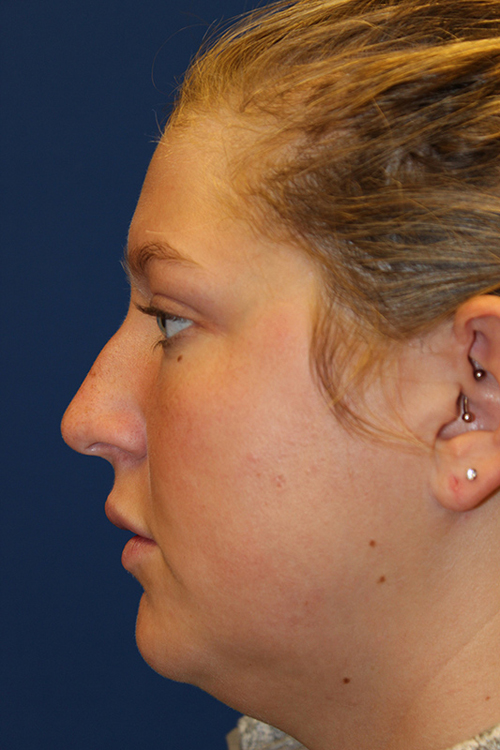 Female Revision Rhinoplasty