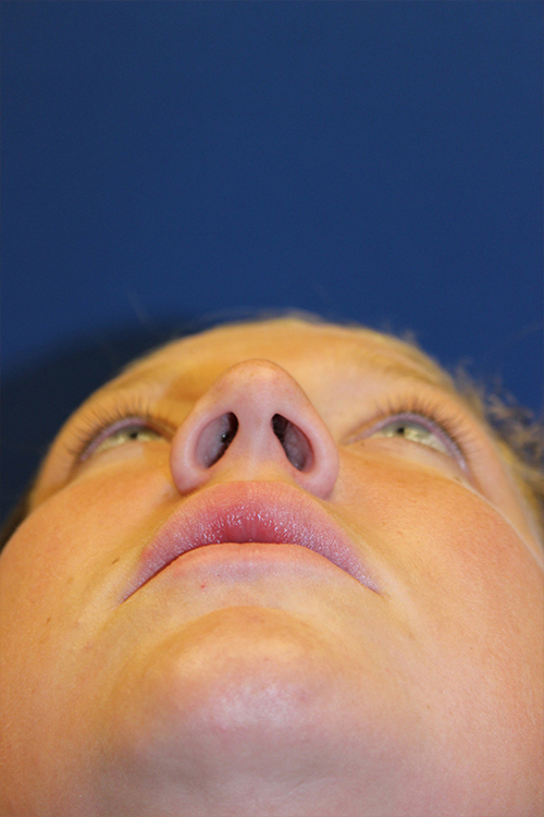 Female Revision Rhinoplasty