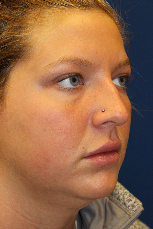 Female Revision Rhinoplasty