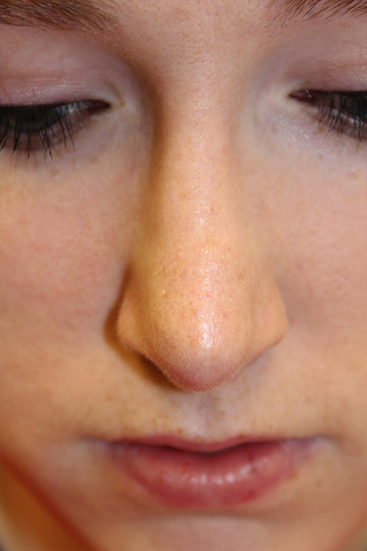 Female Cosmetic Rhinoplasty