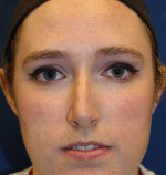 Female Cosmetic Rhinoplasty