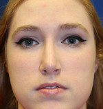 Female Cosmetic Rhinoplasty