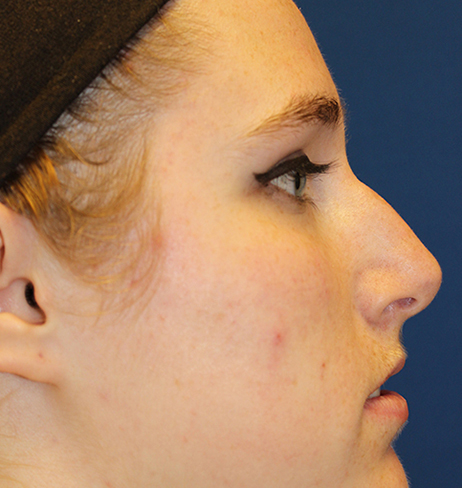 Female Cosmetic Rhinoplasty