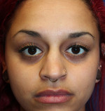 Female Cosmetic Rhinoplasty