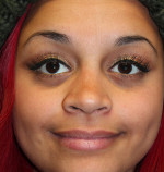 Female Cosmetic Rhinoplasty