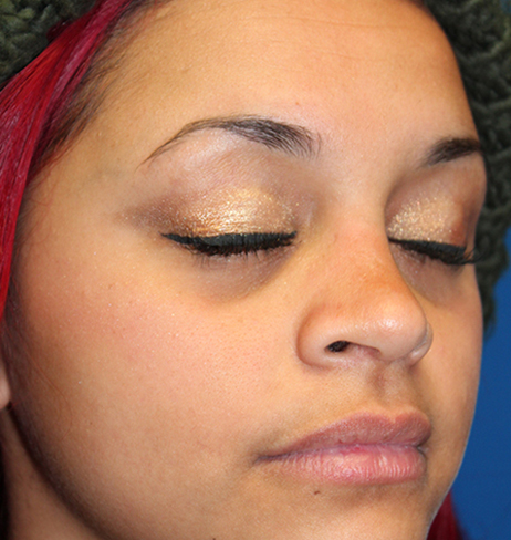 Female Cosmetic Rhinoplasty