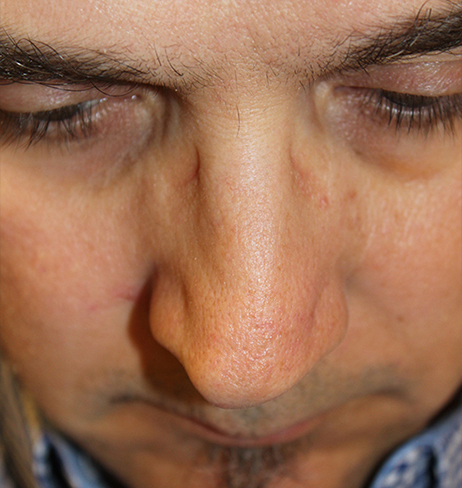 Male Cosmetic Rhinoplasty