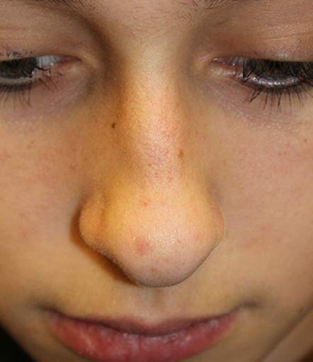 Female Cosmetic Rhinoplasty