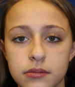 Female Cosmetic Rhinoplasty