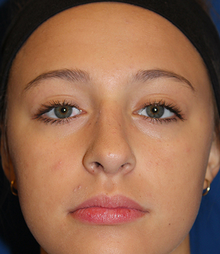 Female Cosmetic Rhinoplasty