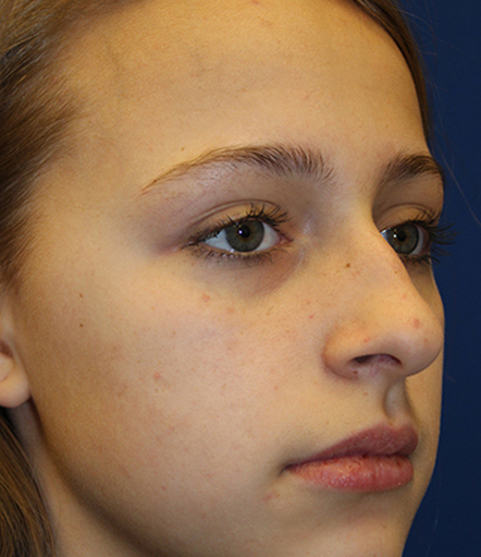 Female Cosmetic Rhinoplasty