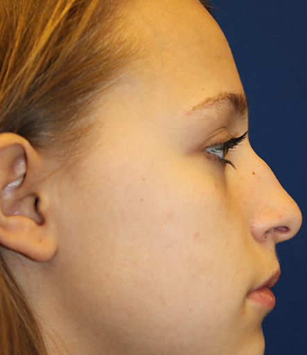 Female Cosmetic Rhinoplasty