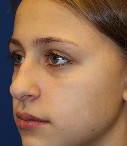 Female Cosmetic Rhinoplasty