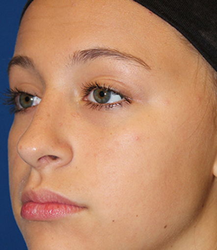 Female Cosmetic Rhinoplasty