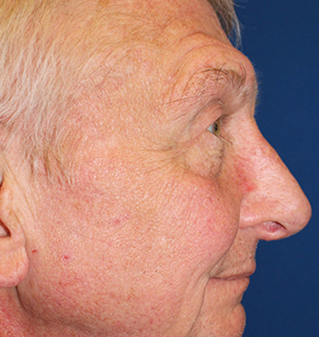 Male Cosmetic Rhinoplasty