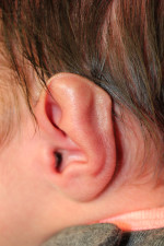 Ear Reshaping