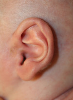 Ear Reshaping