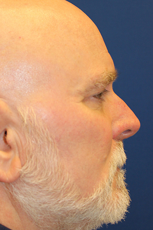 Male Cosmetic Rhinoplasty