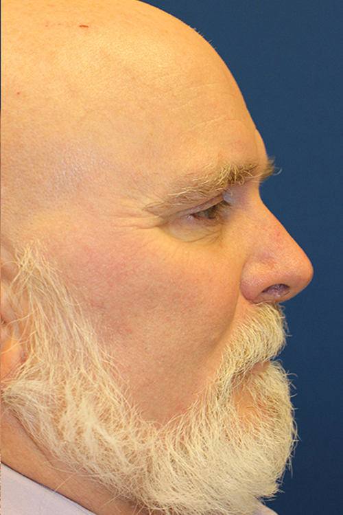 Male Cosmetic Rhinoplasty