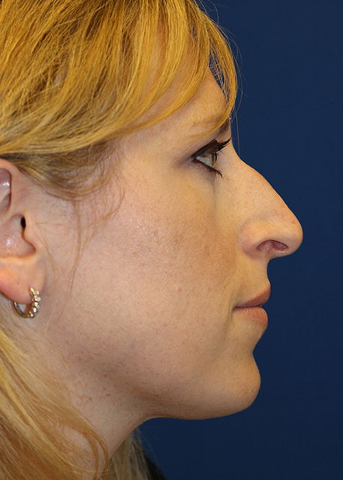 Female Cosmetic Rhinoplasty