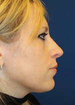 Female Cosmetic Rhinoplasty