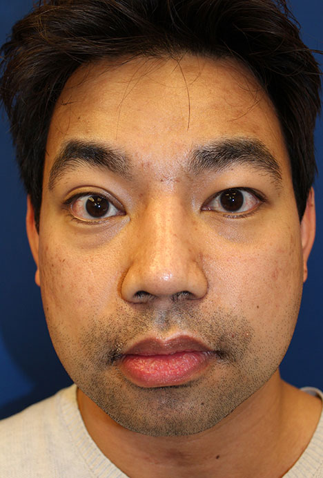 Male Cosmetic Rhinoplasty