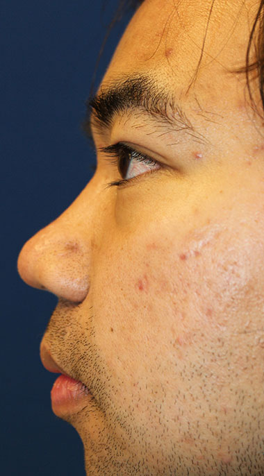 Male Cosmetic Rhinoplasty