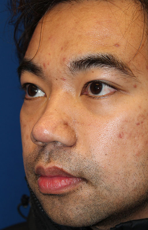 Male Cosmetic Rhinoplasty