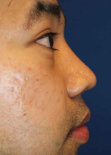 Male Cosmetic Rhinoplasty