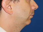 Facial Implants