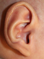 Ear Reshaping
