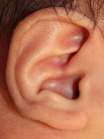 Ear Reshaping