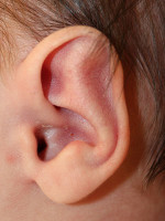 Ear Reshaping