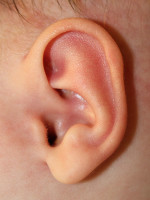 Ear Reshaping