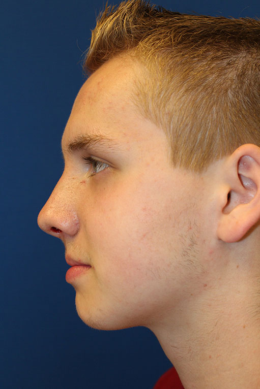 Male Cosmetic Rhinoplasty