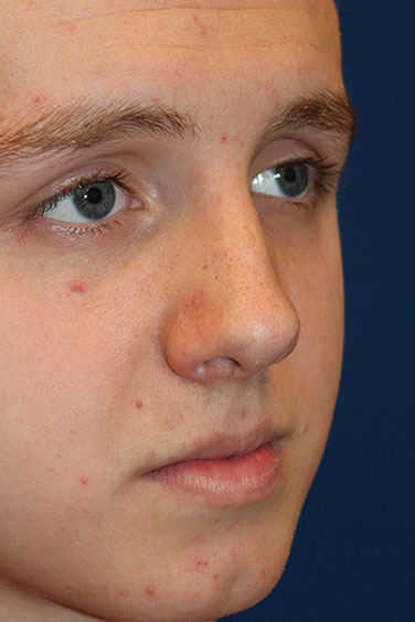 Male Cosmetic Rhinoplasty