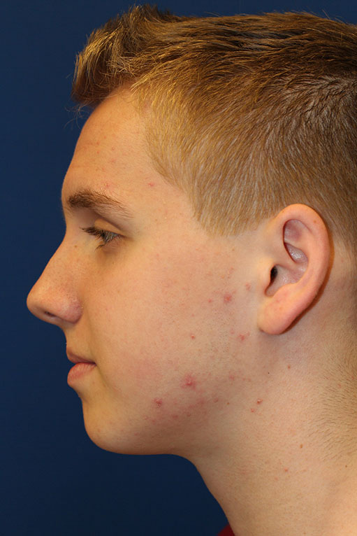 Male Cosmetic Rhinoplasty