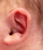 Ear Reshaping