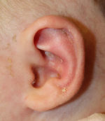 Ear Reshaping