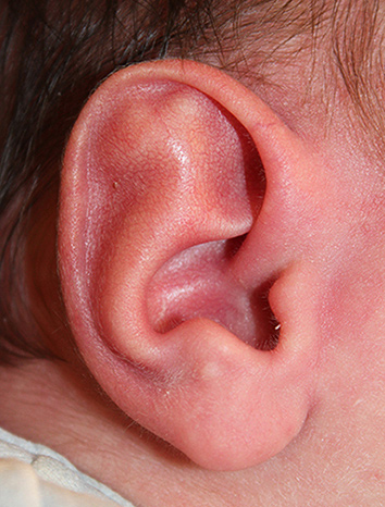 Ear Reshaping