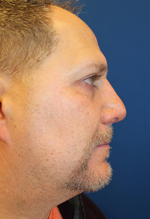 Male Cosmetic Rhinoplasty