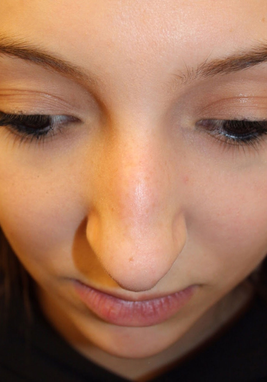 Female Cosmetic Rhinoplasty