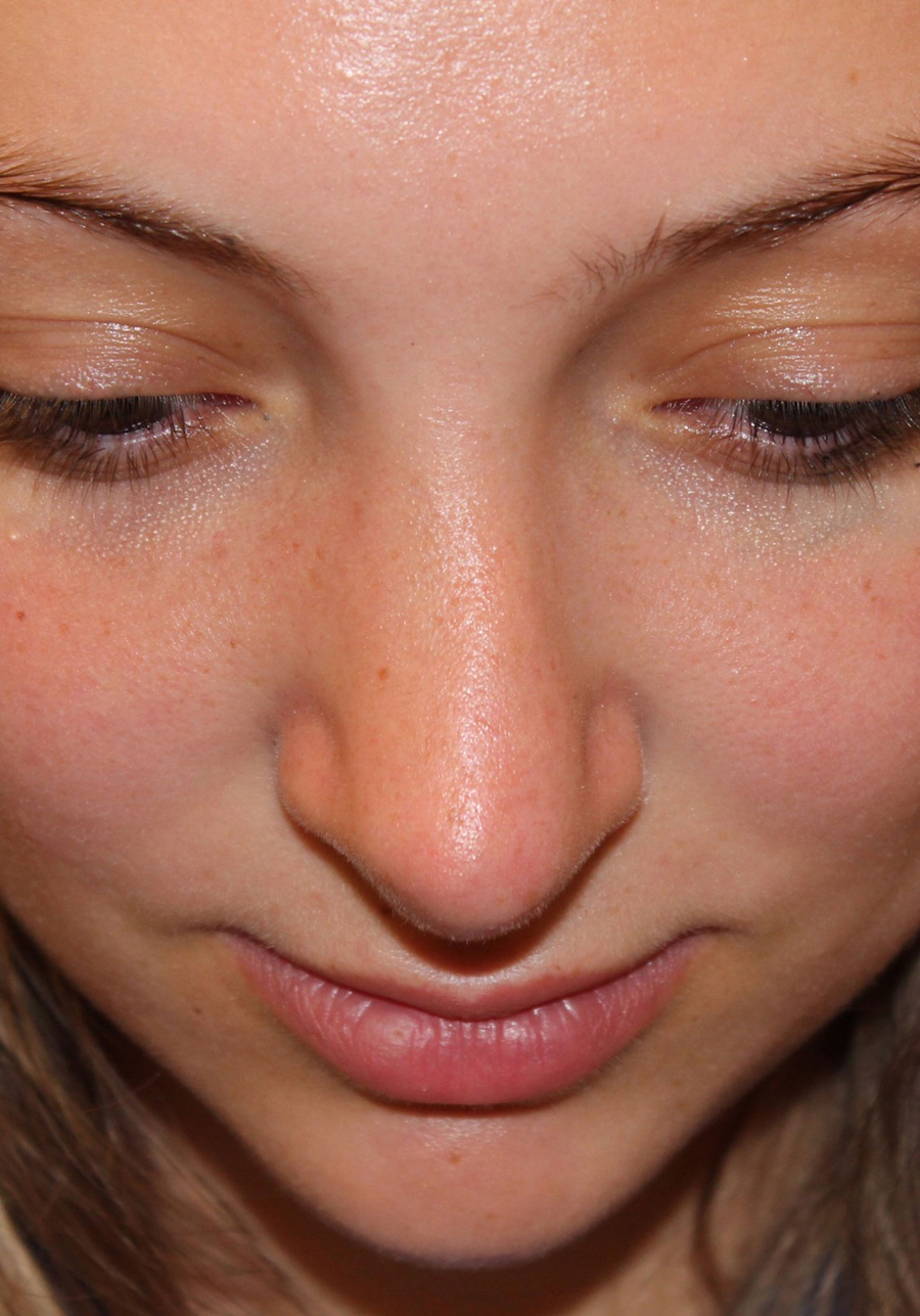 Female Cosmetic Rhinoplasty