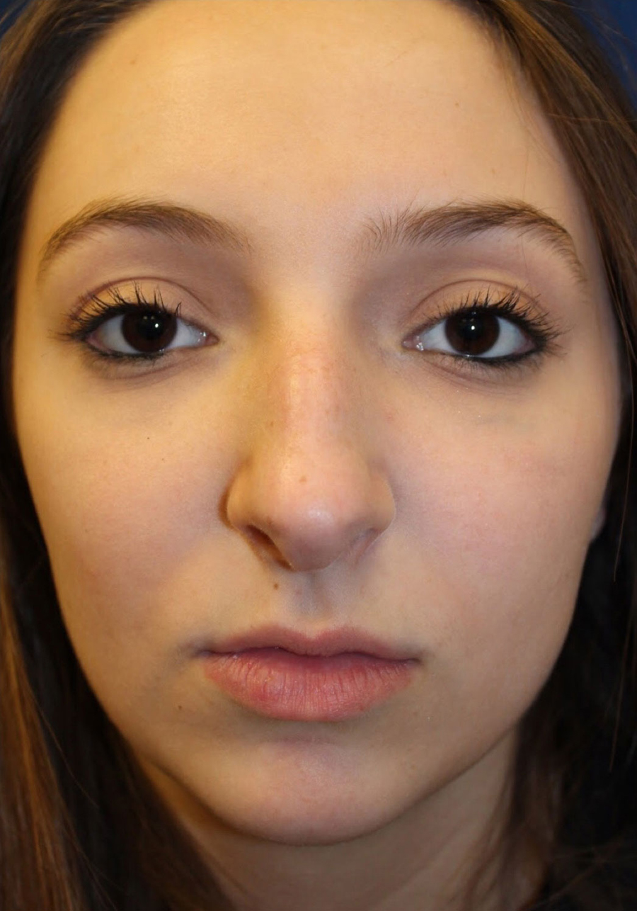 Female Cosmetic Rhinoplasty